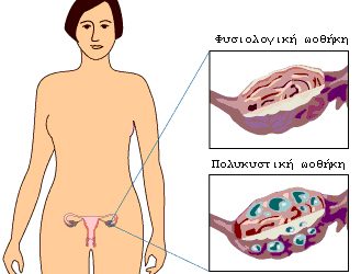 Πολυκυστικές Ωοθήκες 