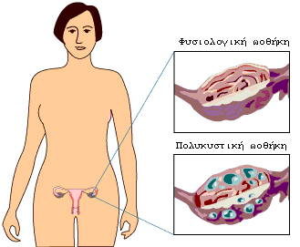 Πολυκυστικές Ωοθήκες